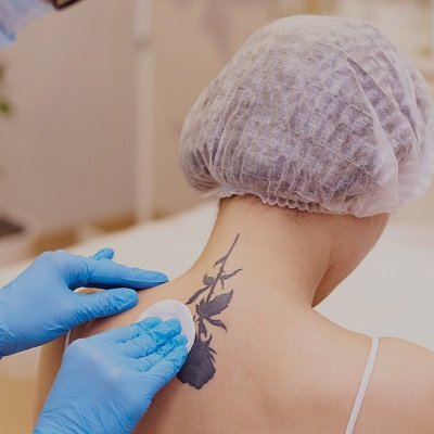 إزالة الوشم في مسقط علاج إزالة الوشم بالليزر في عمان