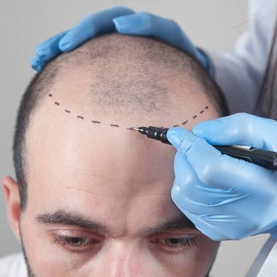 زراعة الشعر بتقنية الشريحة مسقط زراعة الشعر بتقنية الشريحة