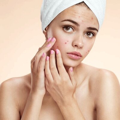 علاج حب الشباب في مسقط علاج حب الشباب في الوجه في عمان