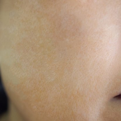 التقشير بالليزر الكربوني التقشير بالليزر الكربوني