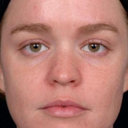 التقشير بالليزر الكربوني التقشير بالليزر الكربوني