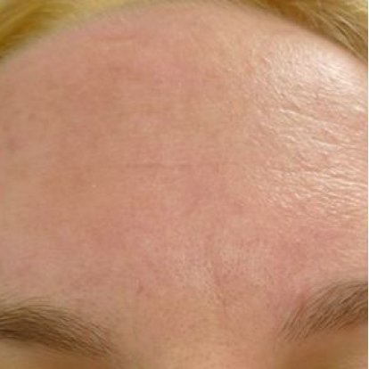 التقشير بالليزر الكربوني التقشير بالليزر الكربوني