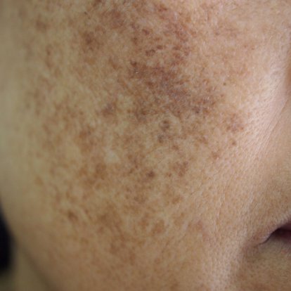 التقشير بالليزر الكربوني التقشير بالليزر الكربوني