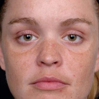 التقشير بالليزر الكربوني التقشير بالليزر الكربوني