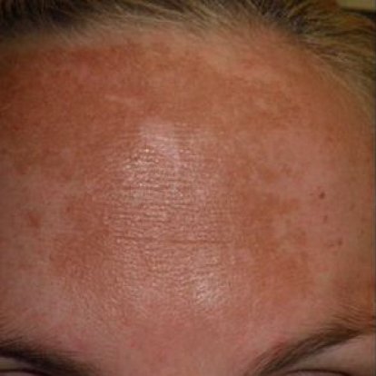 التقشير بالليزر الكربوني التقشير بالليزر الكربوني