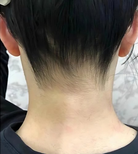 إزالة الشعر بالليزر إزالة الشعر بالليزر