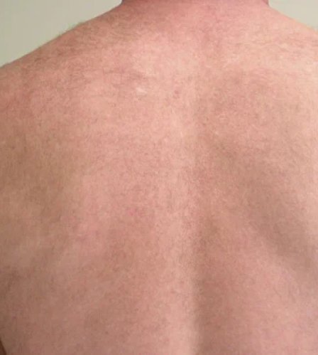 إزالة الشعر بالليزر إزالة الشعر بالليزر