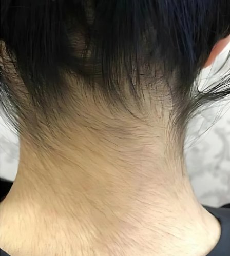 إزالة الشعر بالليزر إزالة الشعر بالليزر