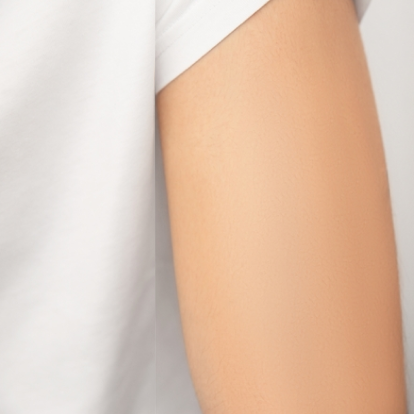 إزالة الوشم بالليزر إزالة الوشم بالليزر