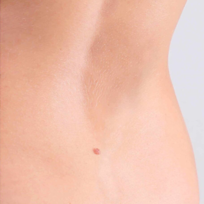 إزالة الوشم بالليزر إزالة الوشم بالليزر