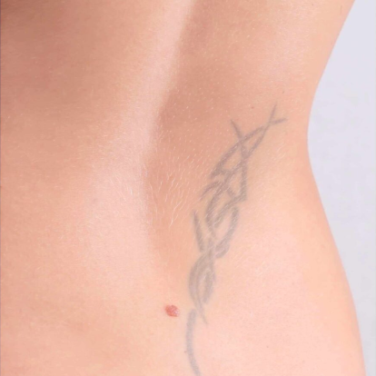 إزالة الوشم بالليزر إزالة الوشم بالليزر