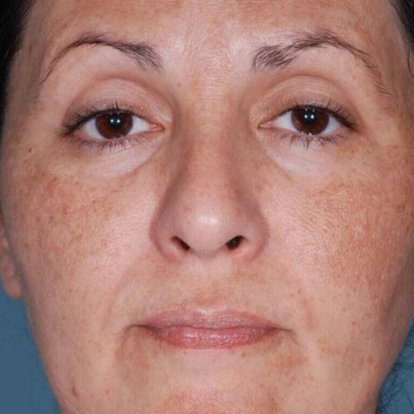 التقشير العضوي التقشير العضوي