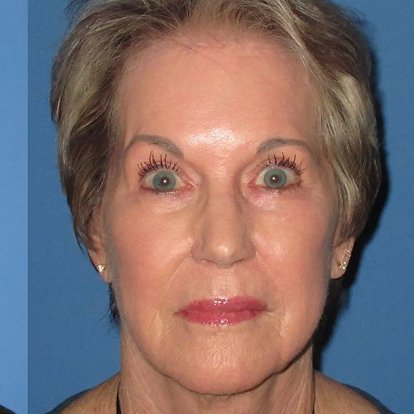 FaceLift FaceLift