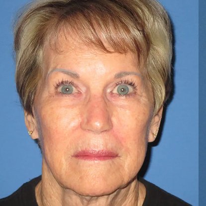 FaceLift FaceLift