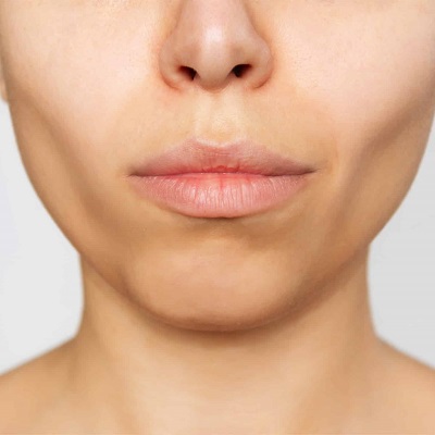 Buccal Fat Removal in Muscat Bichectomy Oman