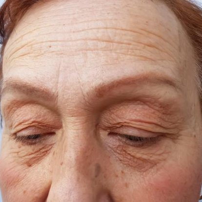 Cosmetic Injectables Cosmetic Injectables