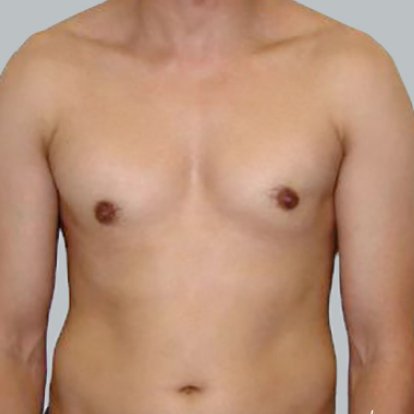 Gynecomastia Gynecomastia