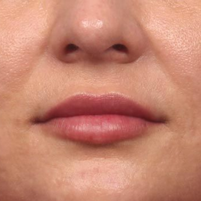 Lip FIllers Lip FIllers