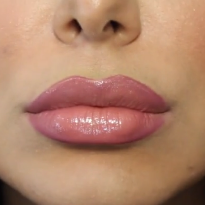 Lip FIllers Lip FIllers