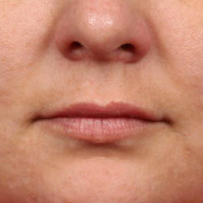 Lip FIllers Lip FIllers