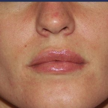 Lip Fillers Lip Fillers