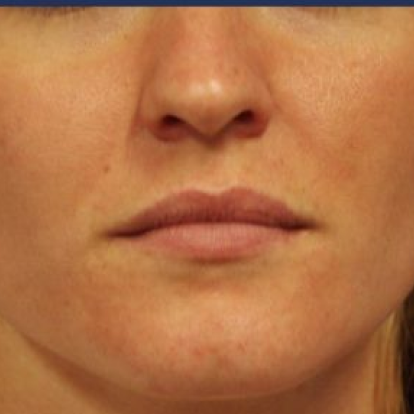 Lip Fillers Lip Fillers