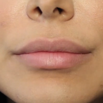 Lip Fillers Lip Fillers