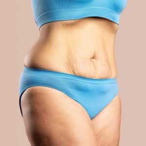 Can Tummy Tuck Remove Belly Fat?