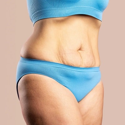 Can Tummy Tuck Remove Belly Fat?