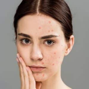 Treatments To Consider If You Have Active Acne