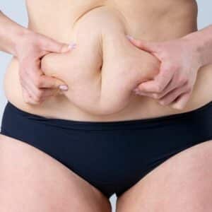 Will I Look Older After Bariatric Surgery