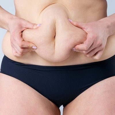 Will I Look Older After Bariatric Surgery