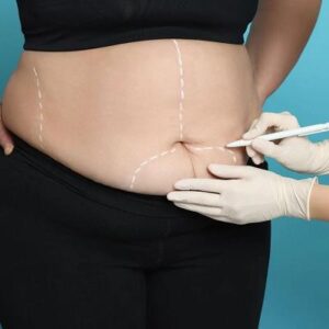 How Does Bariatric Surgery Work for Weight Loss?